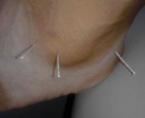 Dry Needling on Ankle